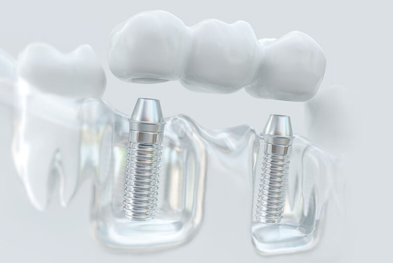 Single dental implant